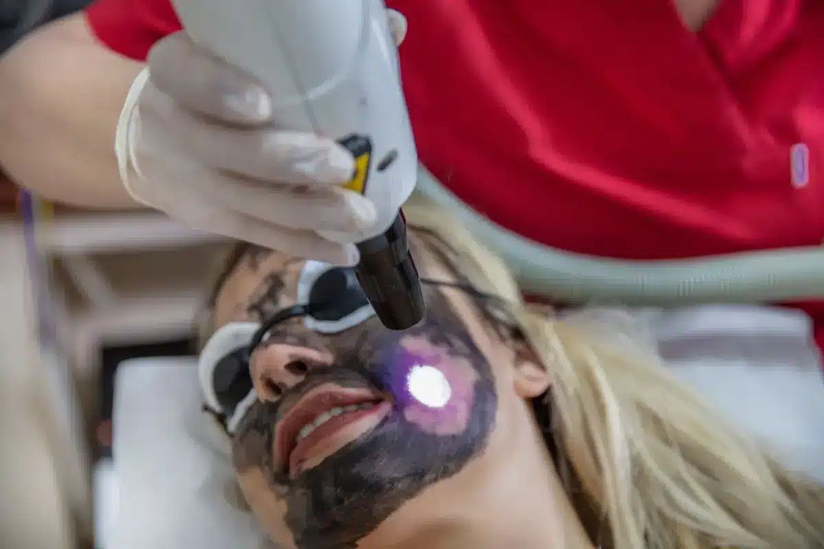 Karbon peeling: Q-switched lazer ile cilt tonu, doku ve gözenek görünümü planlaması